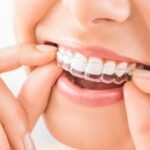 Will People Notice Your Clear Aligners What to Expect