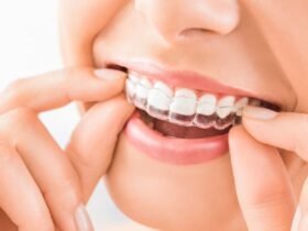Will People Notice Your Clear Aligners What to Expect