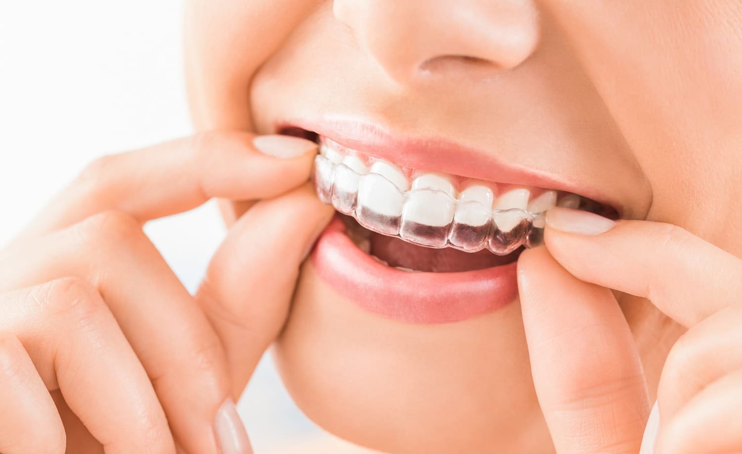 Will People Notice Your Clear Aligners What to Expect