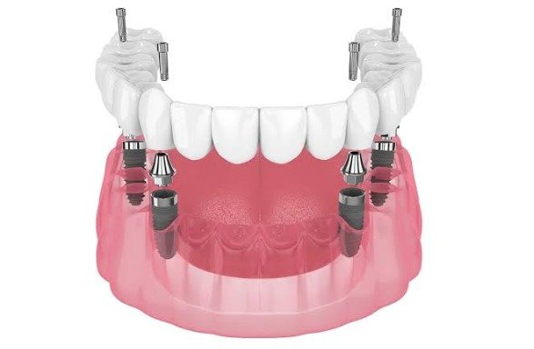 What Factors Affect the Cost of All-on-4 Dental Implants?